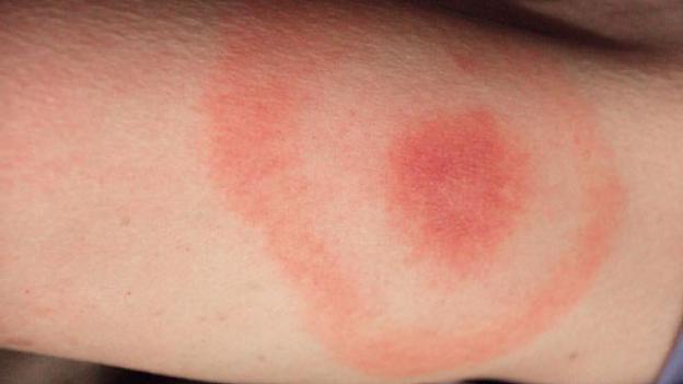 borrelia